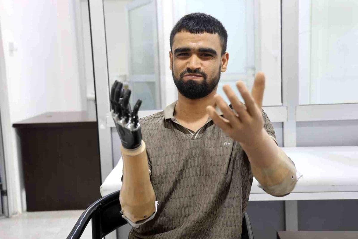 Demirin elektrik tellerine değmesiyle hayatı kararan Muhammed, 3 milyon TL değerindeki protez bacağına ve 2 biyonik koluna kavuştu